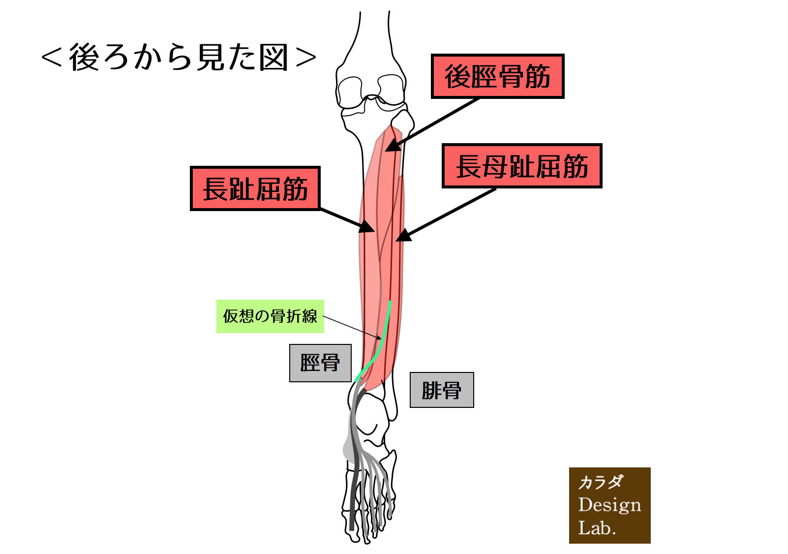 下腿後面深層の筋と仮想の骨折線
