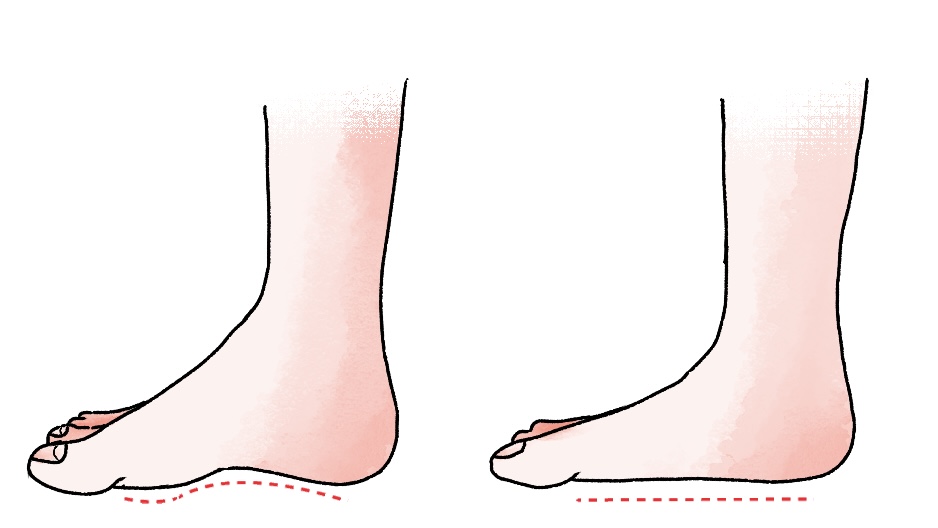 扁平足は『股関節』から治せ！